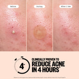 Acne Treatment Dots