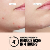 Acne Treatment Dots