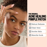 Acne Treatment Dots