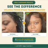 Melasma Power Stack