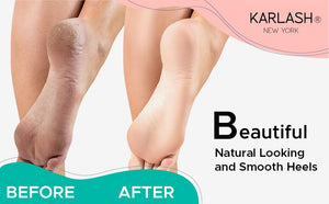 Professional Best Callus Remover Gel for Feet and Foot Pumice Stone Scrubber Kit Remove Hard Skins Heels and Tough Callouses fro
