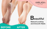 Professional Best Callus Remover Gel for Feet and Foot Pumice Stone Scrubber Kit Remove Hard Skins Heels and Tough Callouses fro